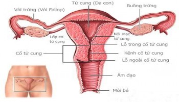 Lạc nội mạc tử cung