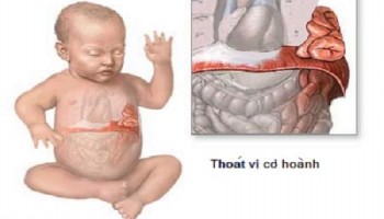 Thoát vị hoành bẩm sinh