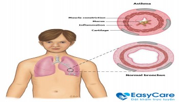 Triệu chứng hen suyễn và cách chống hen hiệu quả