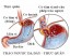 Chứng trào ngược acid dạ dày khi mang thai