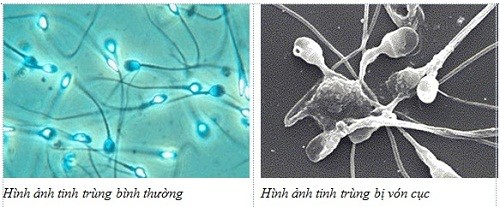 Nguyên nhân khiến tinh dịch vón cục